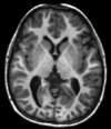 T1-weighted-MRI.png